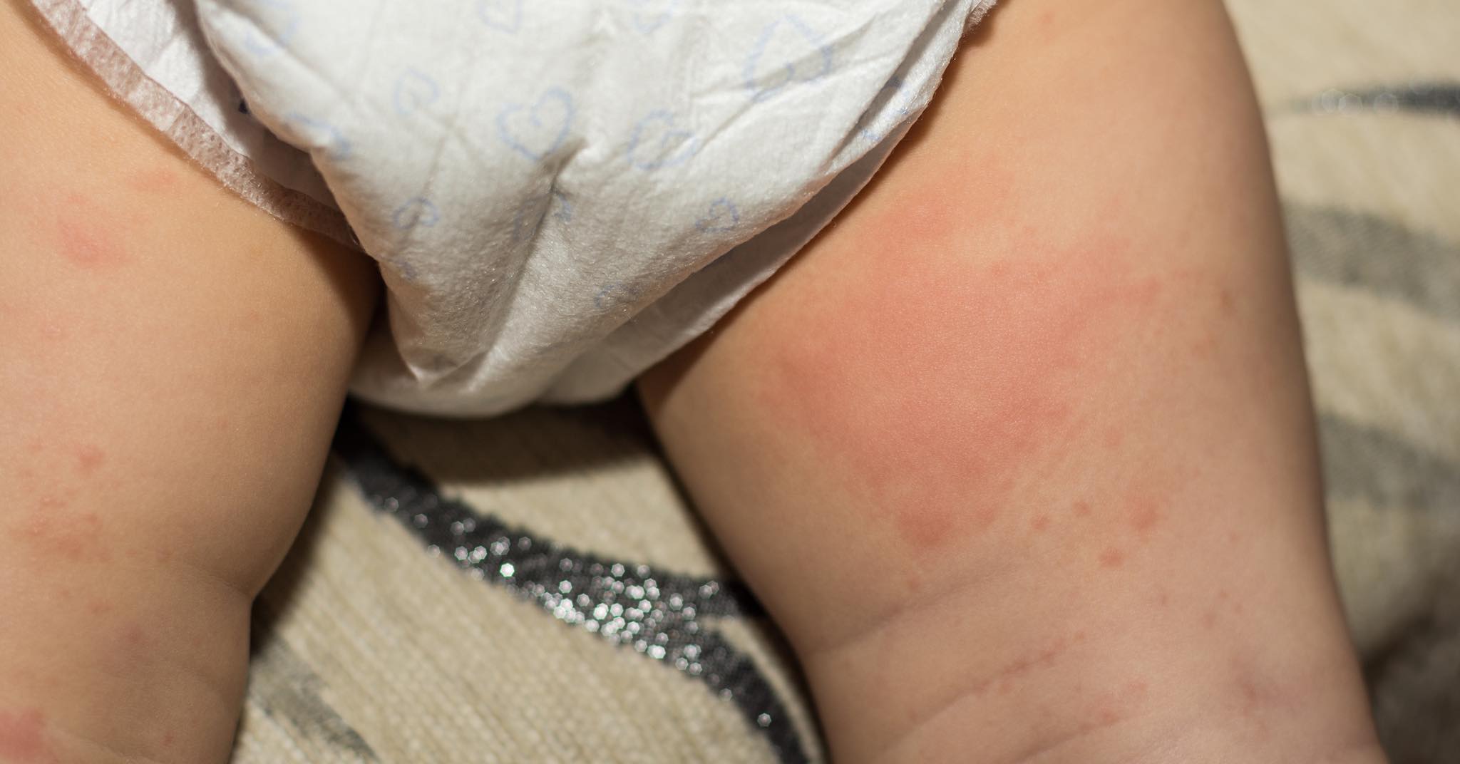 Why Baby Nappy Rash won’t go away